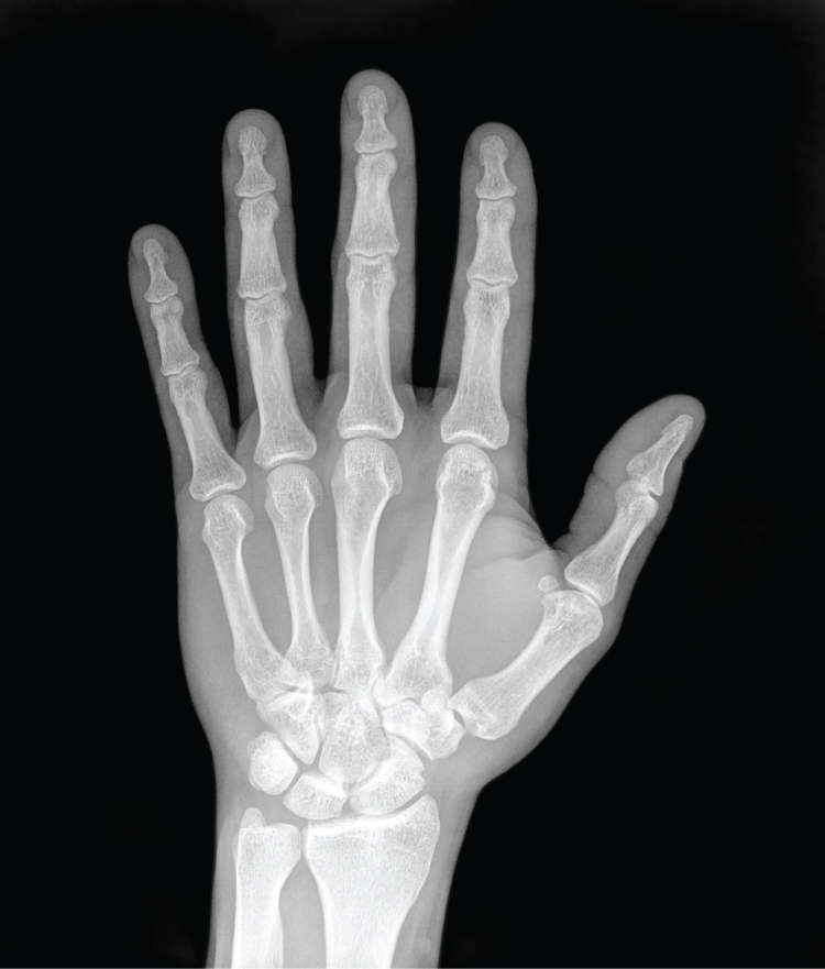 Insights from an Orthopedist: Navigating a Fractured Finger