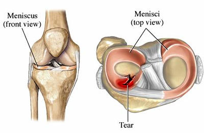 Torn Meniscus in Knee